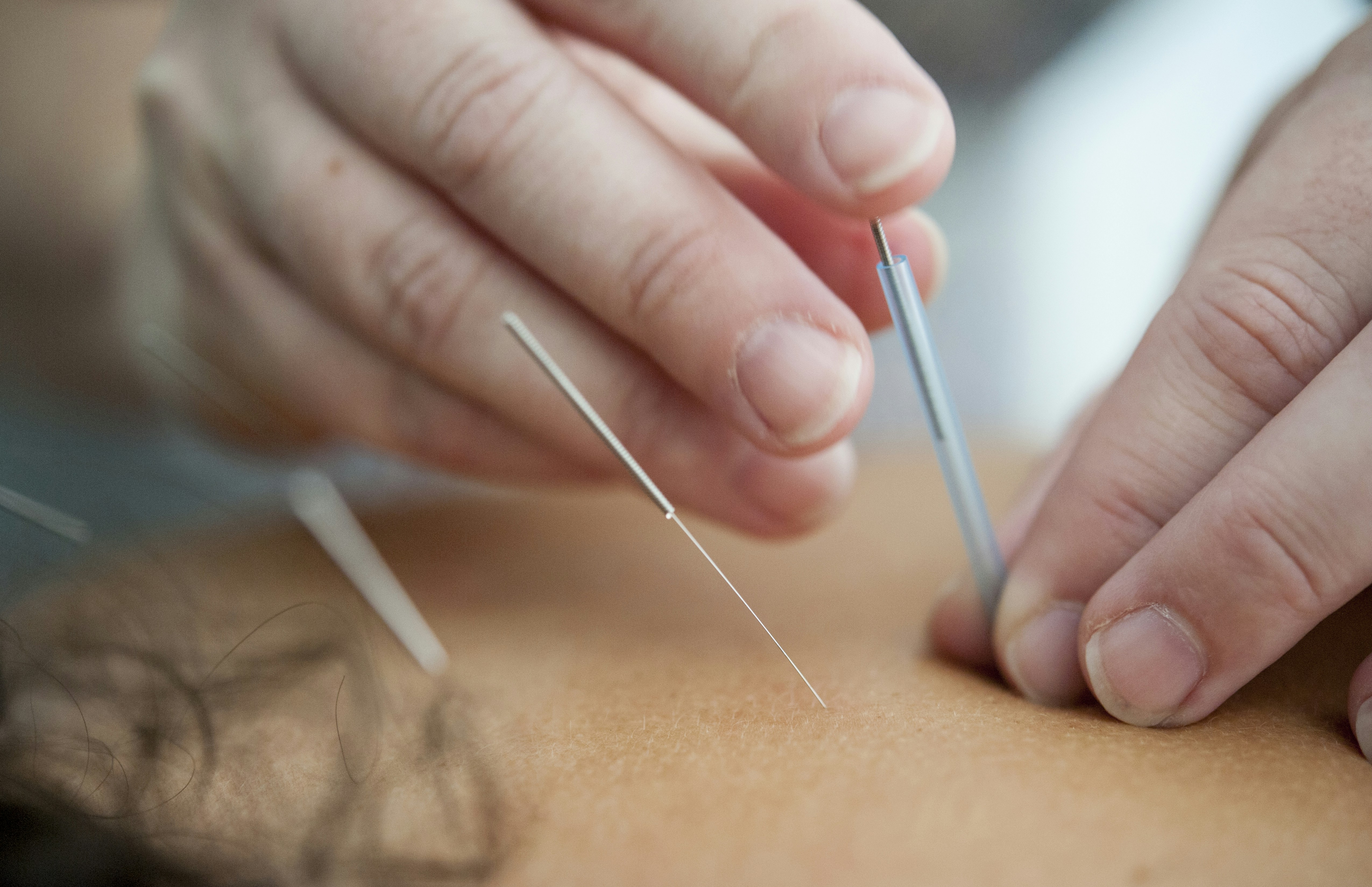 Dry Needling treatment for a sore neck